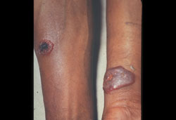 Description: Anthrax: Human, skin. Lesions are raised and have necrotic centers. 